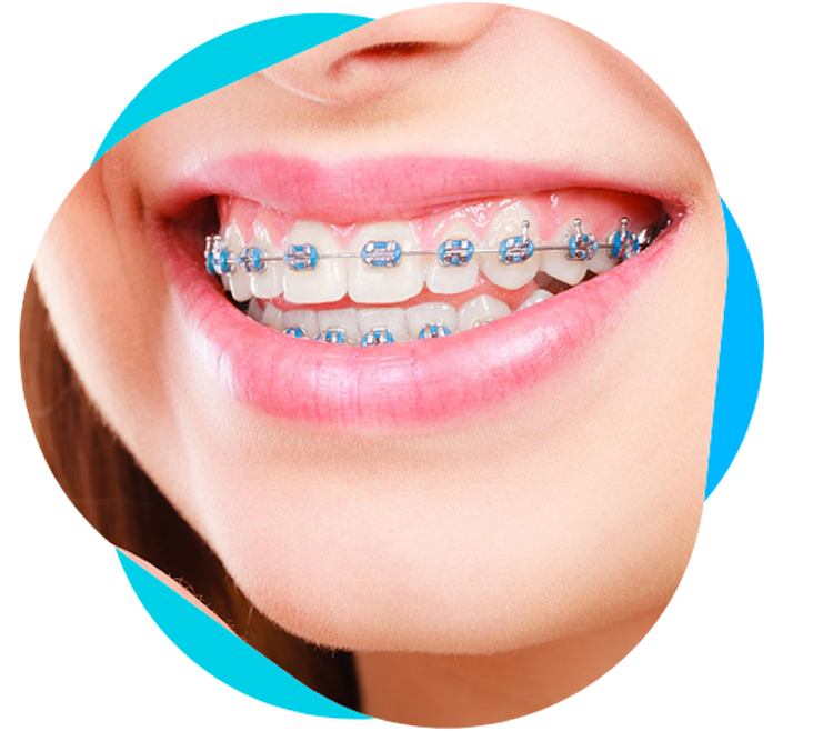 dental-braces-2