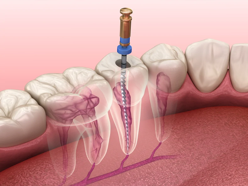 dental-rct-root-canal-treatment