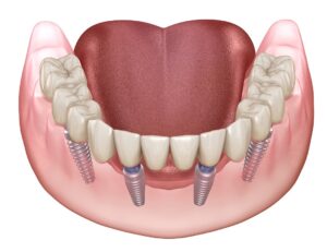 Full mouth rehabilitation