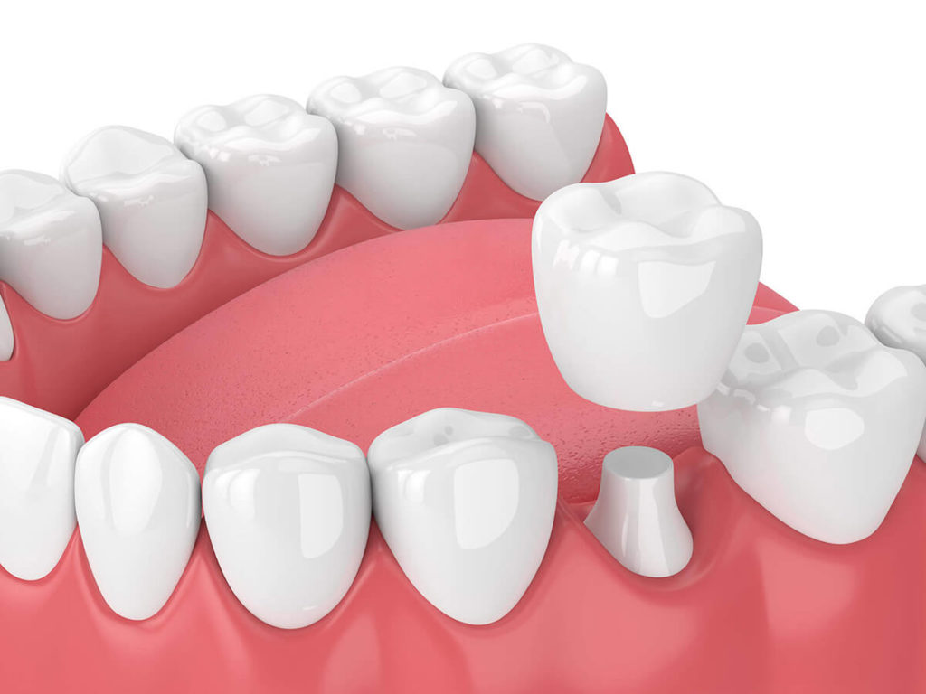 ceramic crowns